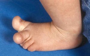 asymmetrische Großwuchs bei einer 2-Jährigen